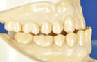 抗菌性手づくりマウスピース製作手順：噛みしめる時の歯の位置、誤り