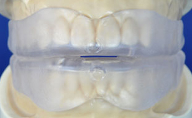 抗菌性マウスピース模型歯型に装着例正面